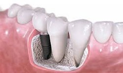 implantes